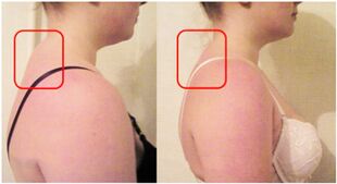 Formación dun coxín muscular na osteocondrose cervical