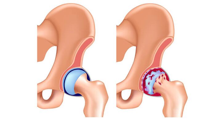 articulación da cadeira sa e artrótica